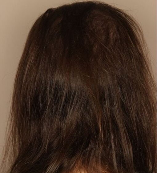J'ai arrêté la perte de cheveux avec Verdexedil