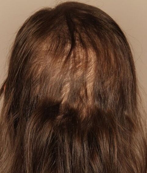 Perte de cheveux avant d'utiliser le spray Verdexedil